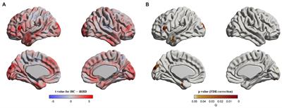Static and dynamic brain morphological changes in isolated REM sleep behavior disorder compared to normal aging